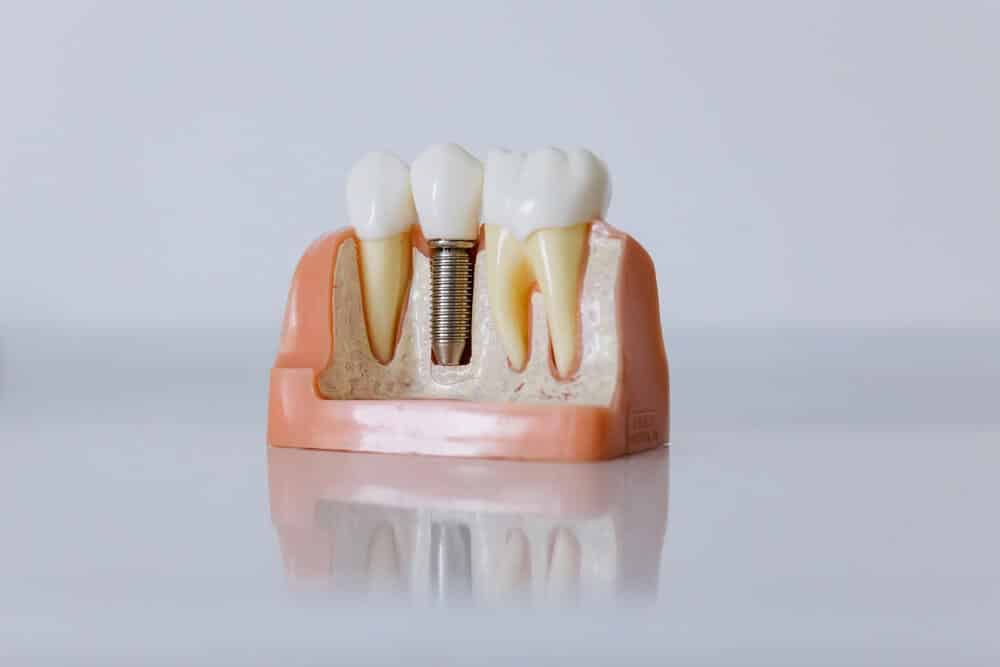 Increase Dental Implant Clinic Traffic On Website Through SEO: Fresno CA Content Marketing Expert